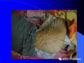 宣蛰人银质针视频,揭秘传统中医的神奇疗效